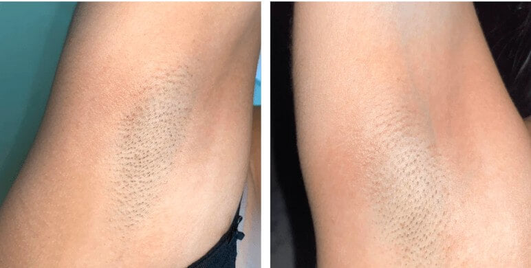Woman showing armpits and underarms after using vevor IPL treatment for hair removal after 2 weeks befor and after