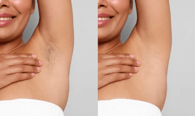 Close-up before and after photo of a woman's armpit demonstrating effective hair removal using the Vevor IPL device