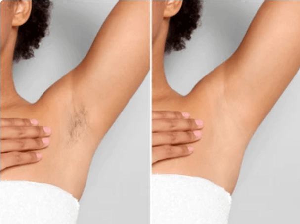 Side-by-side comparison image demonstrating successful underarm hair removal, contrasting the 'before' image with the smooth, hair-free 'after' result from Vevor IPL