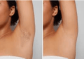 Hair removal results on an armpit showing a before image with hair and an after image with smooth, clear skin from Vevor IPL treatment