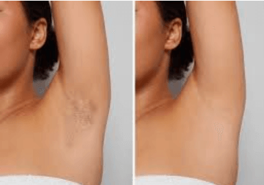 Hair removal results on an armpit showing a before image with hair and an after image with smooth, clear skin from Vevor IPL treatment