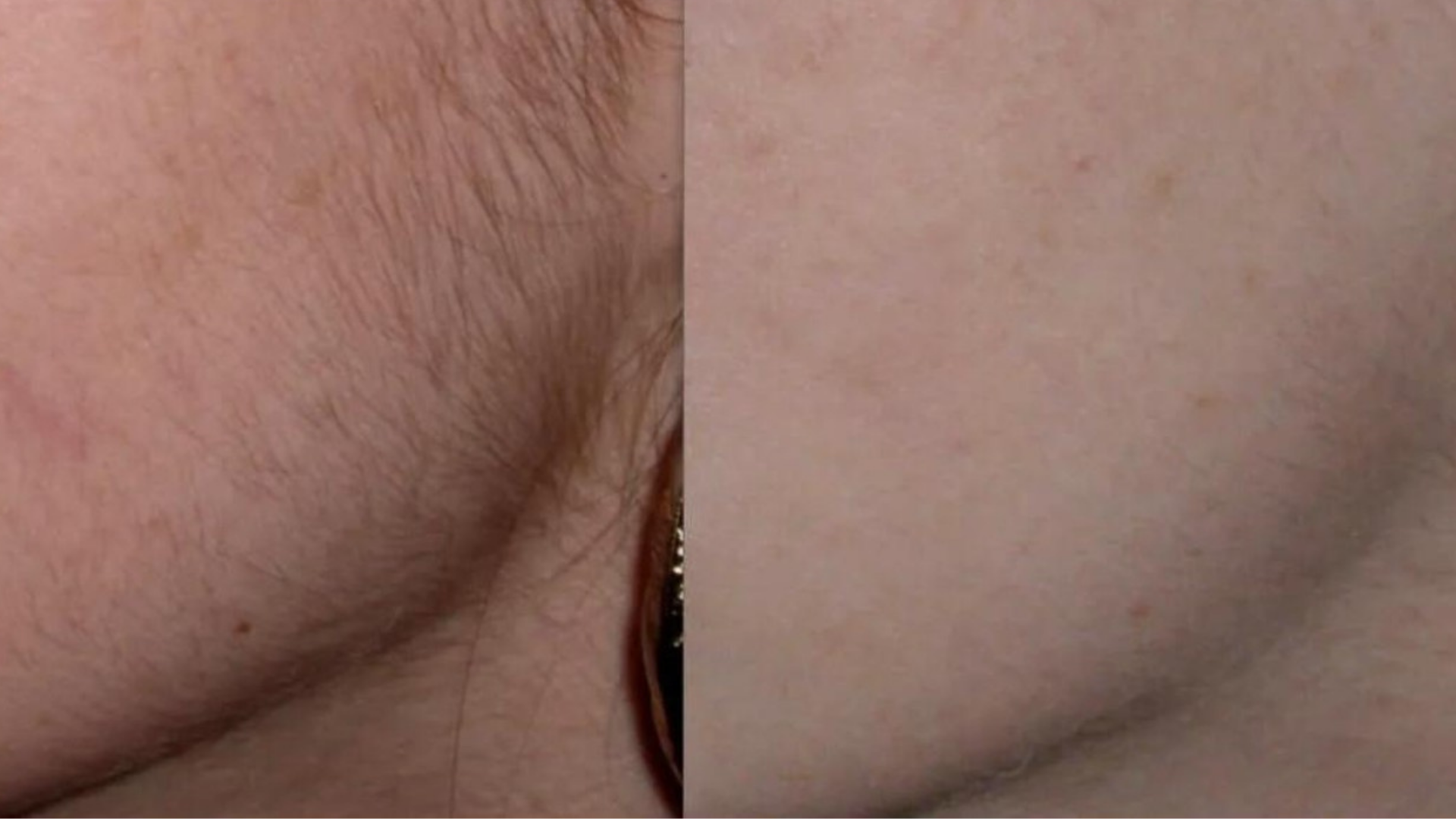 Woman Showing Facial Hair Before After IPL Laser Hair Removal Treatment