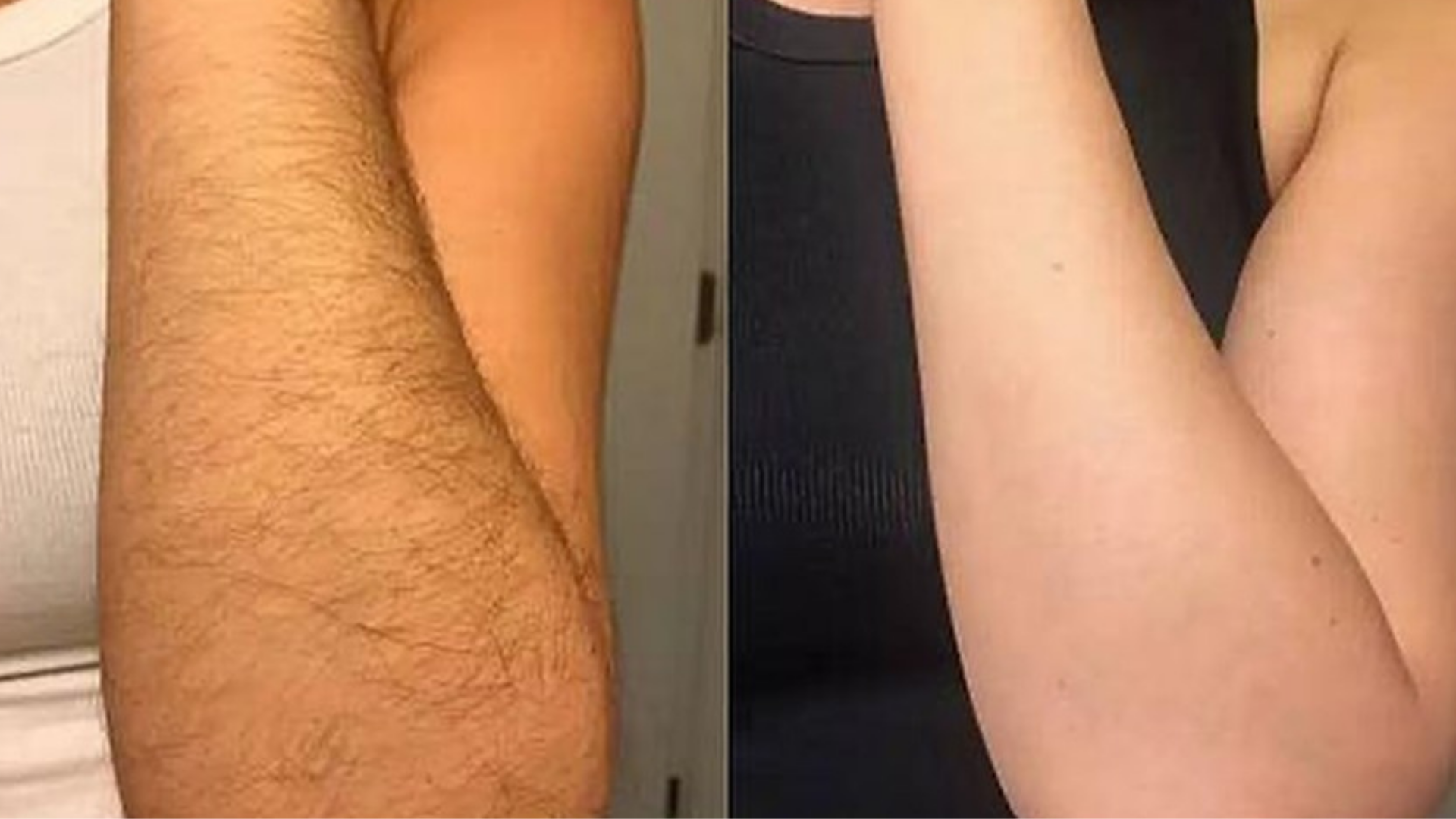 Lady Showing Forearms Before After IPL Laser Hair Removal Treatment