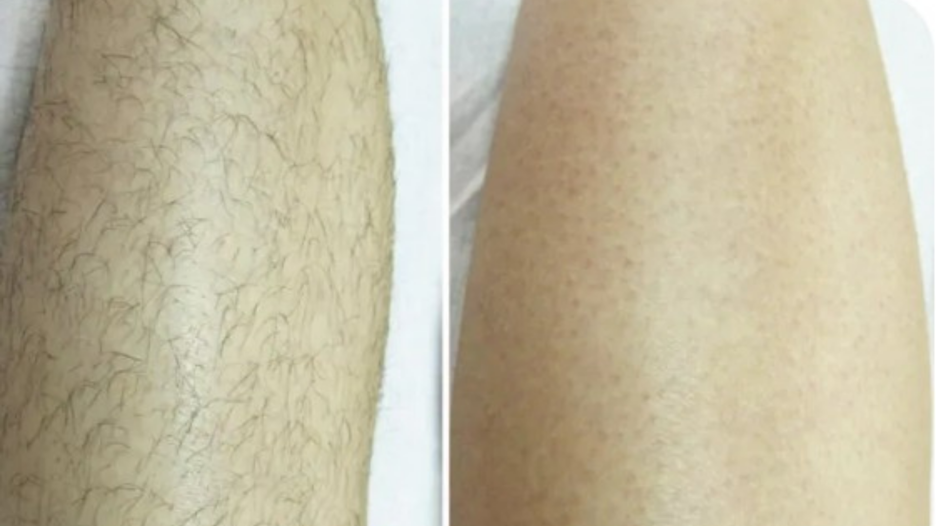 Man Legs Before After IPL Laser Hair Removal Treatment