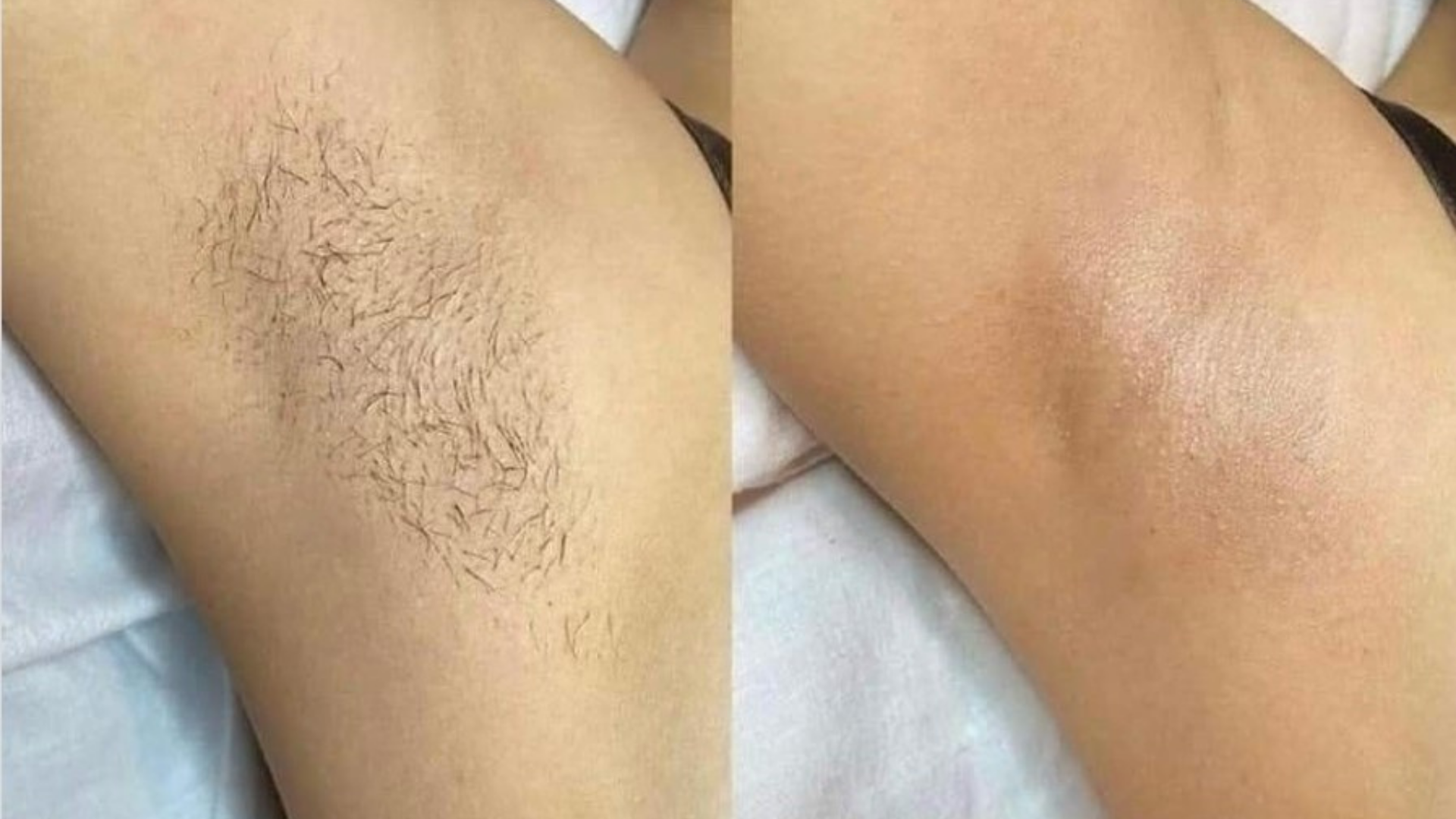 Lady Showing Underarms Armpits Before After IPL Laser Hair Removal Treatment