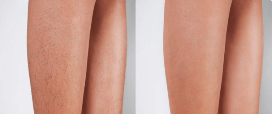Before and after photo comparing a hairy leg with a smooth, hair-free leg to demonstrate the effective results of the Vevor IPL hair removal device