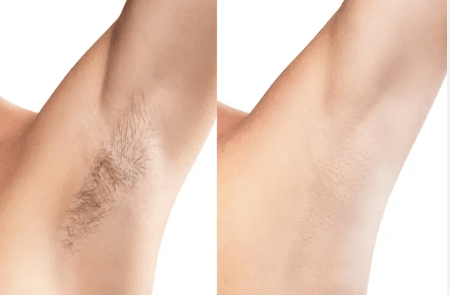 Side-by-side comparison of a woman's armpit showing significant hair reduction and smooth skin after using the Vevor IPL device