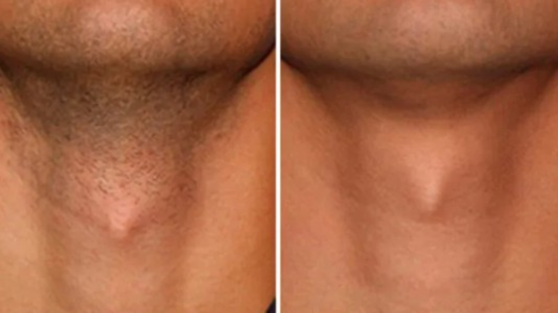 Male showing Beard Chin Neck Before After IPL Laser Hair Removal Treatment