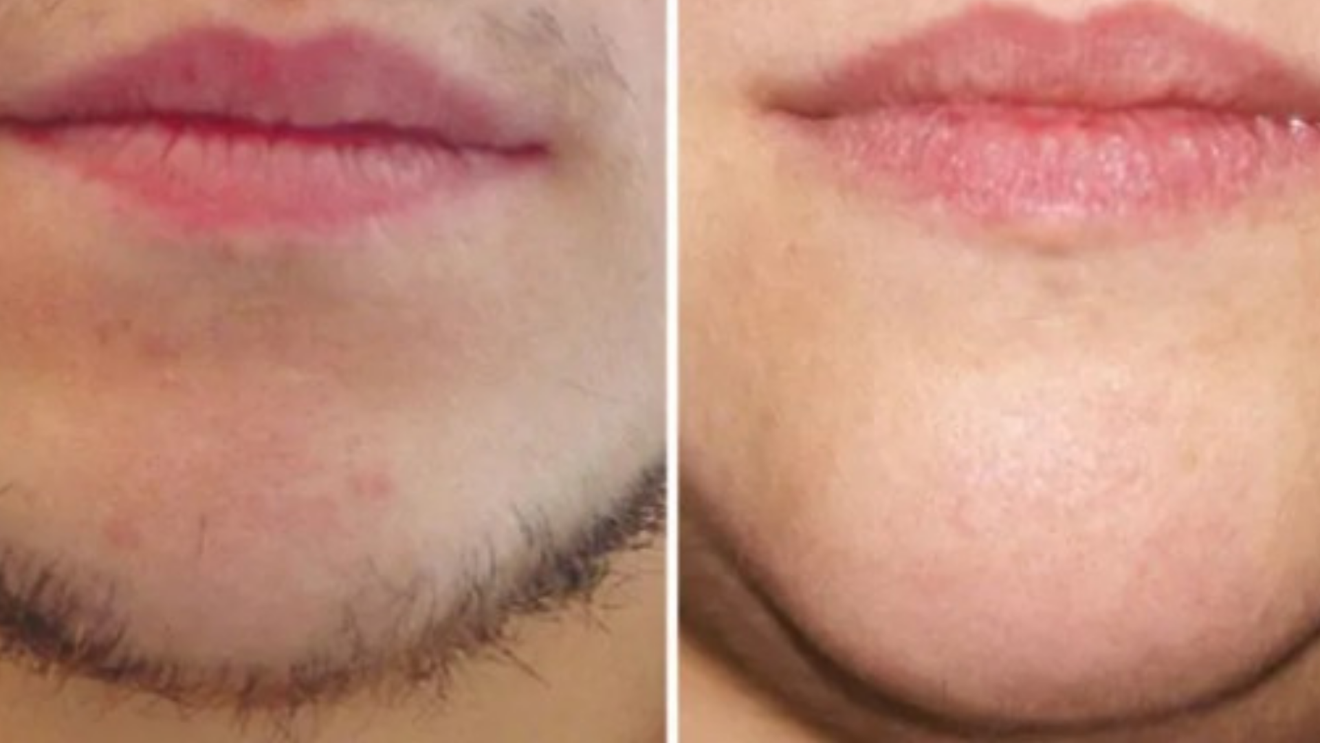 Man Showing Beard Chin Face Before After IPL Laser Hair Removal Treatment