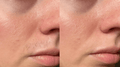 Before and after close-up photo of a woman's upper lip demonstrating effective removal of facial hair/peach fuzz using the Vevor IPL device