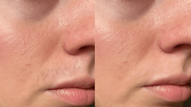 White Woman Face and Lips after using Vevor IPL Hair Removal Device Treatment for 1 week