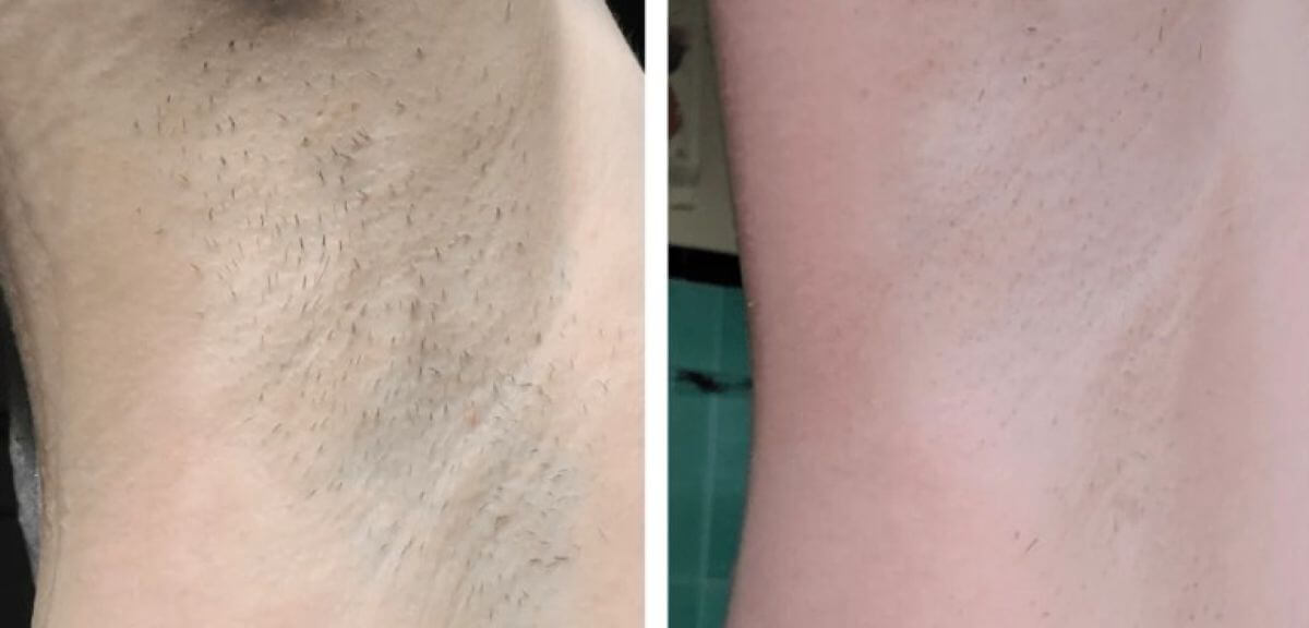 Woman Before and After Picture of Armpit and Underarms after using vevor IPL treatment for hair removal for 2 weeks