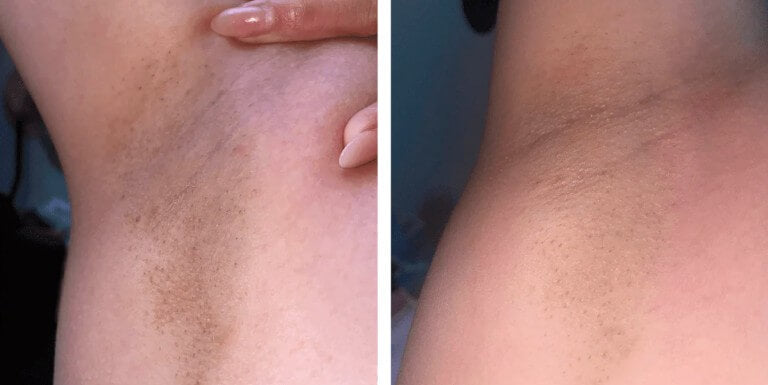 Woman showing Armpit and Underarms after using Vevor IPL Treatment for Hair Removal for 3 Weeks Before and After Pic