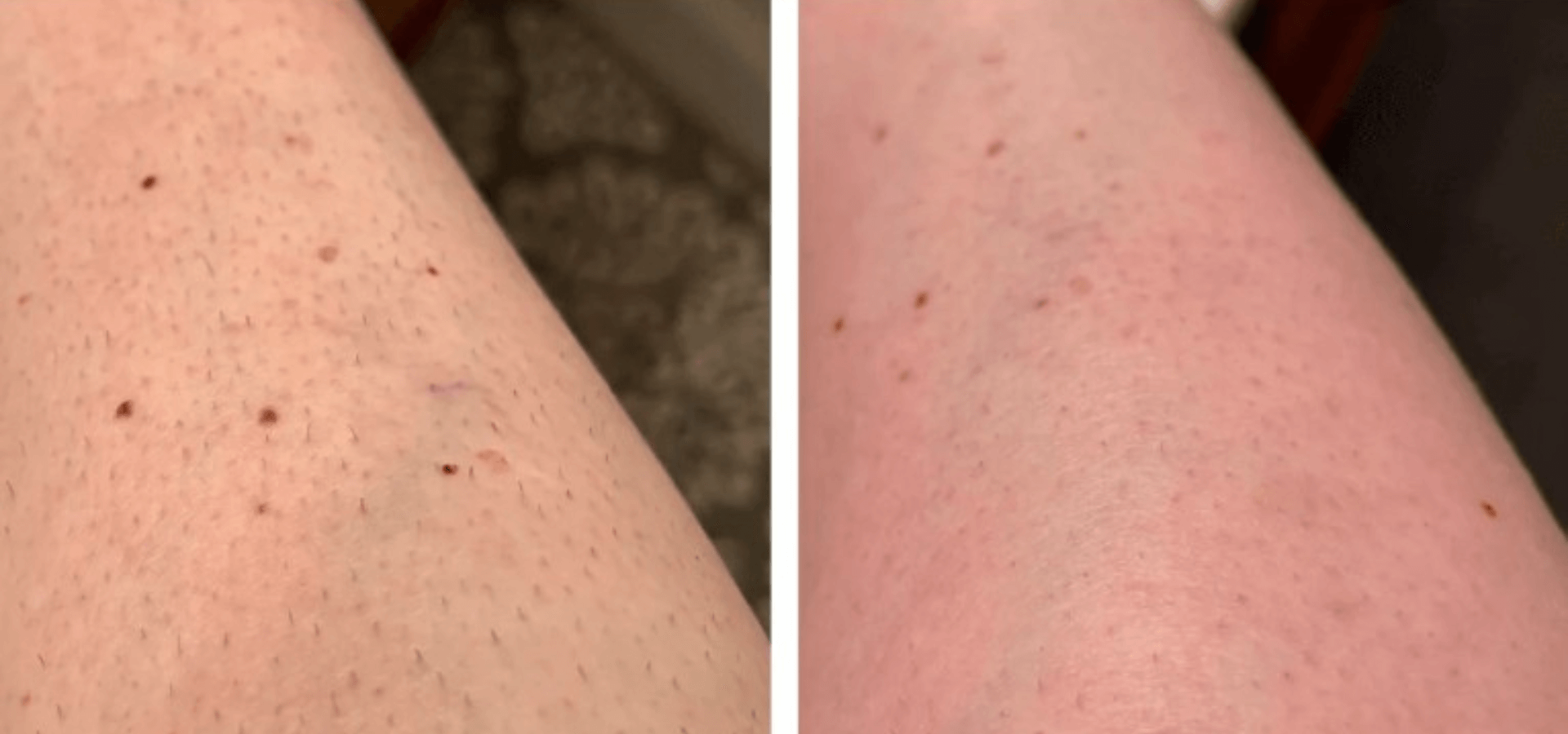 White Woman Legs Forearms after using Vevor IPL Hair Removal Device Treatment for 2 weeks