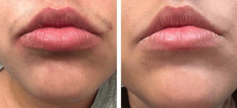 Woman Face and Lips after using Vevor IPL Hair Removal Device Treatment for 1 week