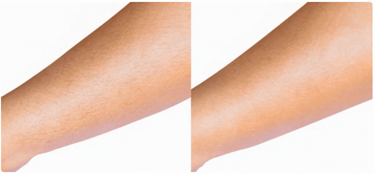 Forearm hair removal before and after results, clearly showing a side with hair and a side with smooth, hair-free skin after Vevor IPL treatment