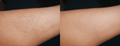 Close-up before and after photo of a woman's arm showing removal of fine forearm hair, demonstrating smooth skin achieved with the Vevor IPL device