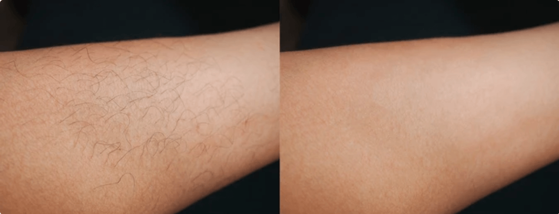 Close-up before and after photo of a woman's arm showing removal of fine forearm hair, demonstrating smooth skin achieved with the Vevor IPL device