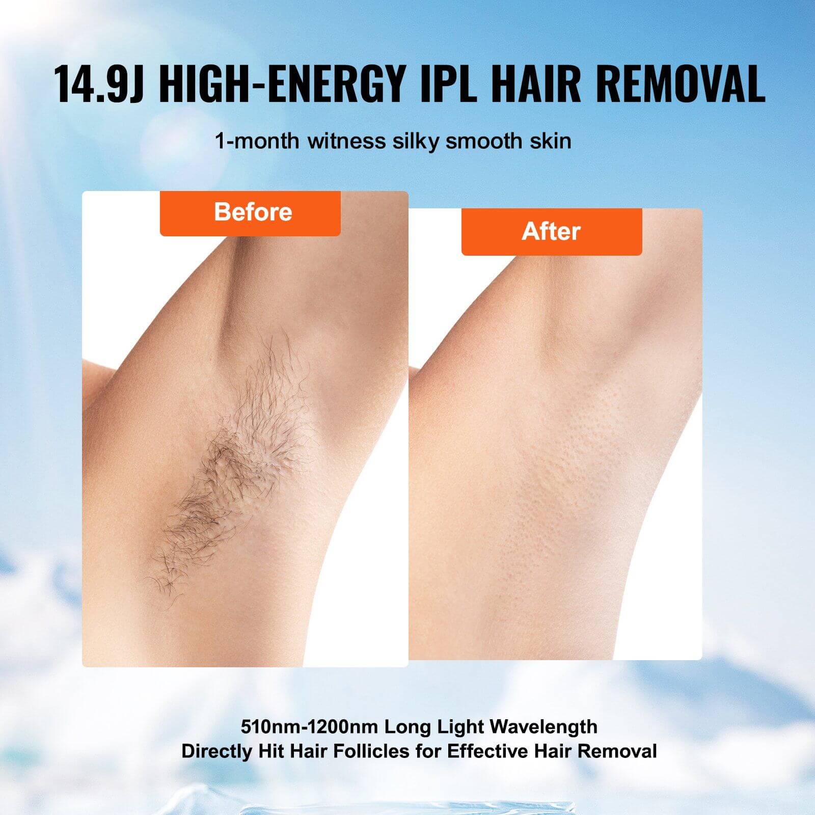 Before and after comparison of hair removal results using 14.9J High-Energy IPL, showing smooth skin after 1-month treatment